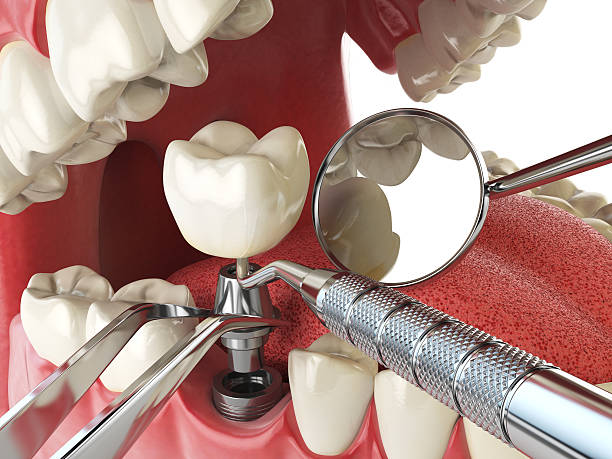 Best Knocked-Out Tooth (Avulsed Tooth) Treatment in Rochester, PA